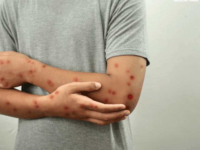 ﻿Oman Mpox Symptoms Protection